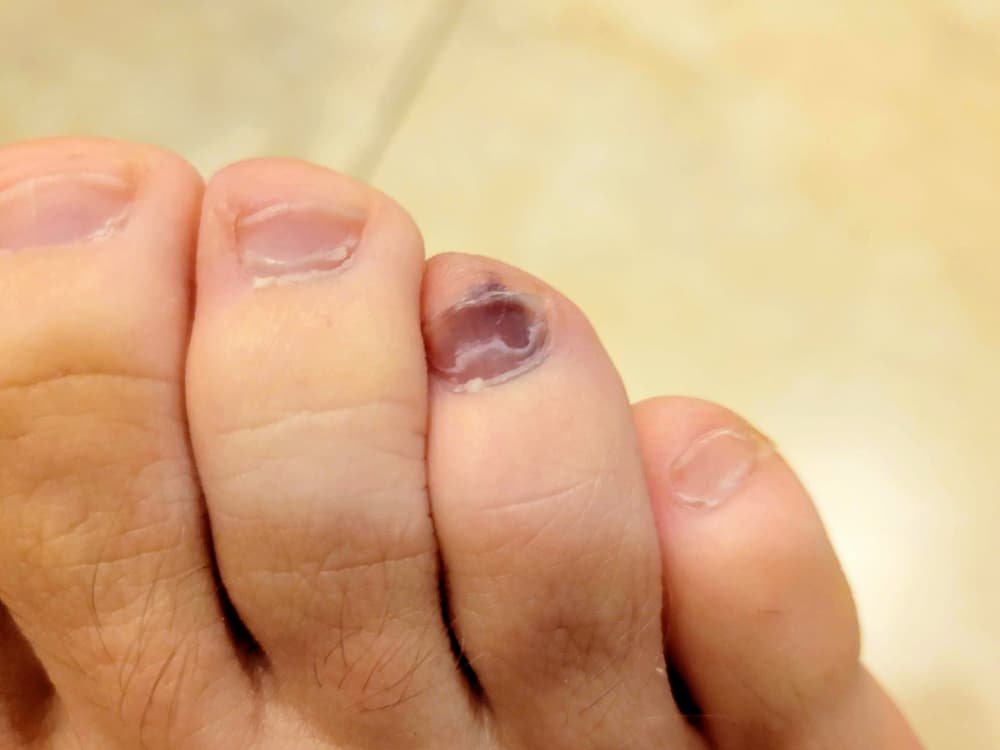 Bruised toe