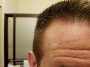 Mole on my forehead