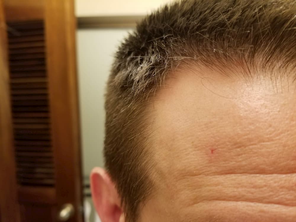 Mole on my forehead