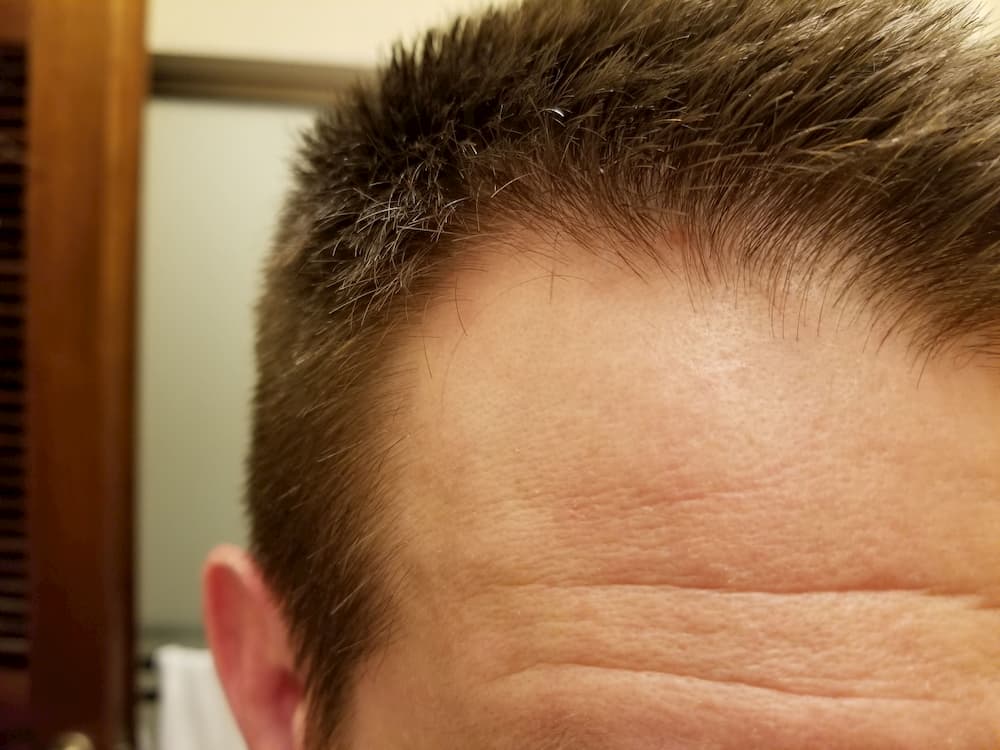No more mole on my forehead!