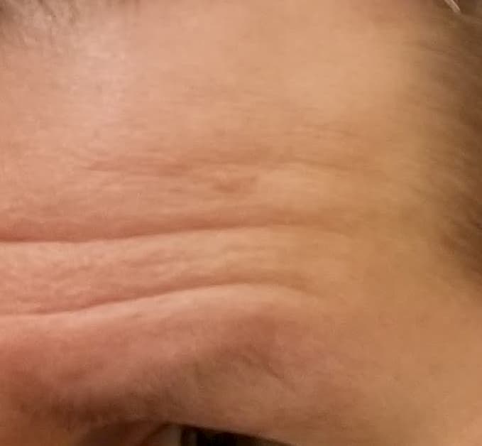My Test Run of Medical Service in Panama Went Awry - Mole on My Forehead